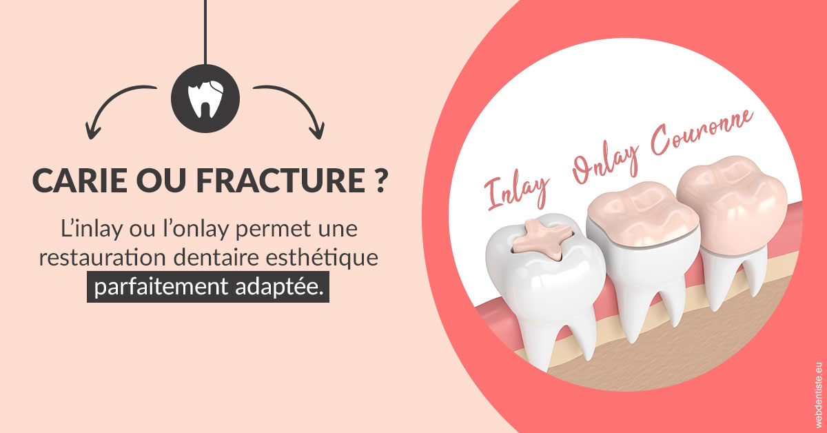 https://dr-daas-marwan.chirurgiens-dentistes.fr/T2 2023 - Carie ou fracture 2