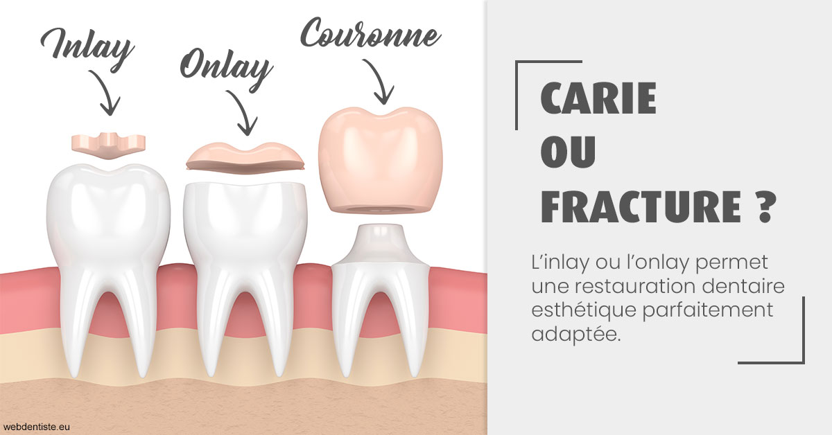 https://dr-daas-marwan.chirurgiens-dentistes.fr/T2 2023 - Carie ou fracture 1