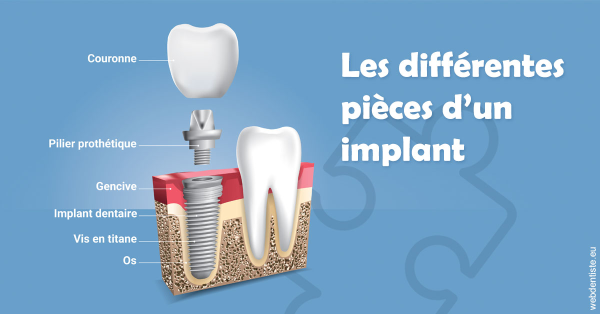 https://dr-daas-marwan.chirurgiens-dentistes.fr/Les différentes pièces d’un implant 1
