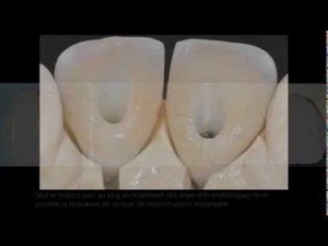 Greffe osseuse, implants dentaires remplaçant deux incisives centrales, couronnes céramiques
