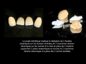Implants dentaires, agénésie des incisives latérales, facettes et couronnes céramiques