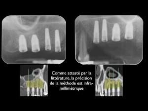 Implantologie assistée par ordinateur: remplacement de toutes les dents postérieures