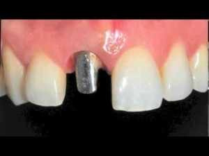 Implant dentaire remplaçant une incisive centrale, pilier en zircone et couronne céramo-céramique